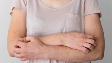 Penyakit Kusta di Rumania