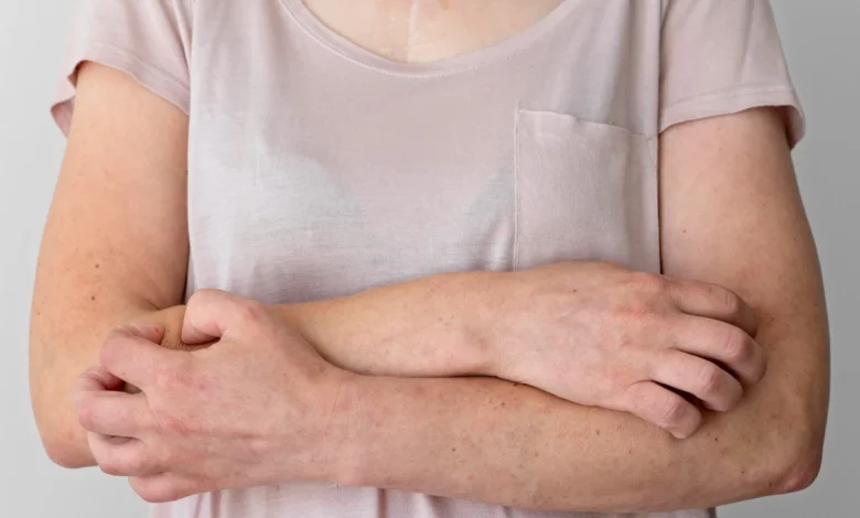 Penyakit Kusta di Rumania